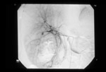 Selective embolisation of the right hepatic artery 