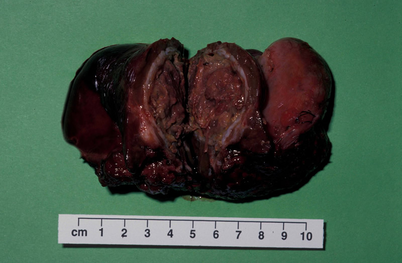 adenoma liver